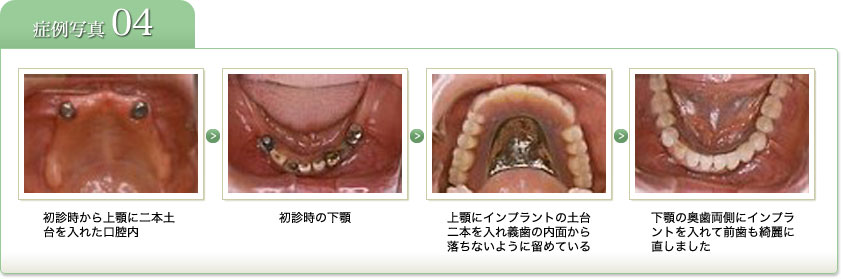 症例写真4