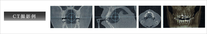 CT撮影例